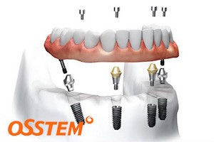 Преимущества Osstem в имплантации зубов